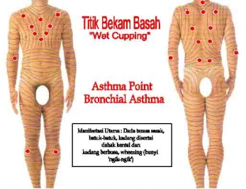 wet-cupping-asthma1.jpg