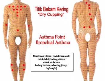 dry-cupping-asthma.jpg