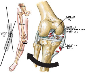 valgus_acl.jpg