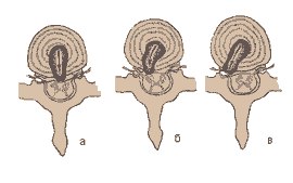 Дискэктомия поясничного отдела лфк