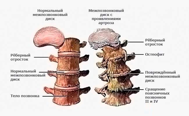 Лечение остеохондроза поясничного отдела позвоночника