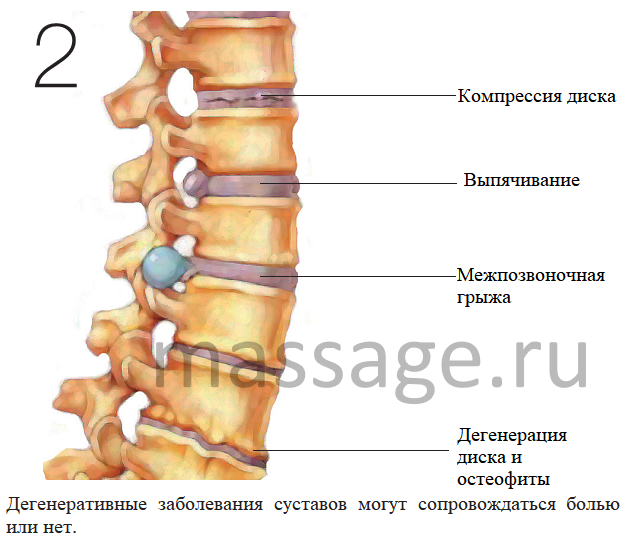 osteochondrosis l5)