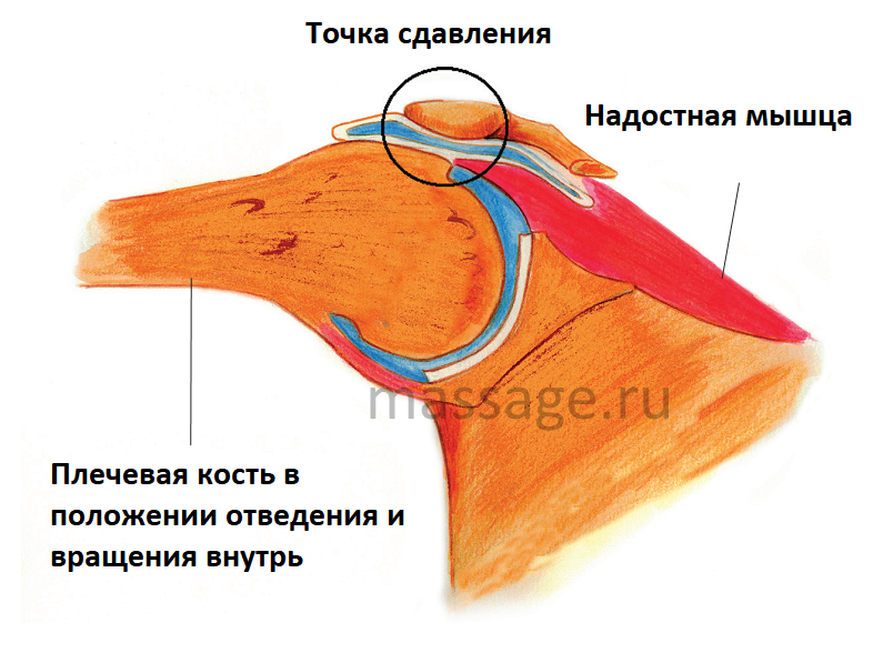 Синдром малой грудной мышцы массаж