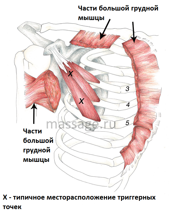 Синдром малой грудной мышцы массаж