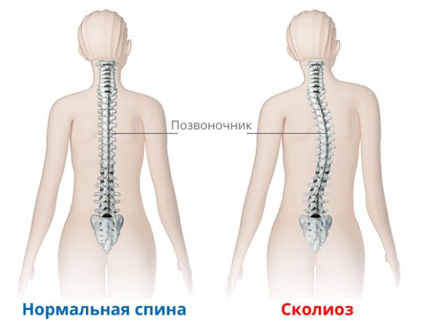 С-образный сколиоз